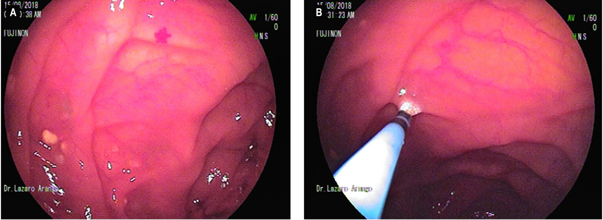 Figura 3. A. Lesiones lipomatosas del yeyuno y una angiodisplasia al lado. B. Terapia con argón plasma de la lesión lipomatosa ulcerada y de la angiodisplasia. Imágenes tomadas por el Dr. Lázaro Arango.