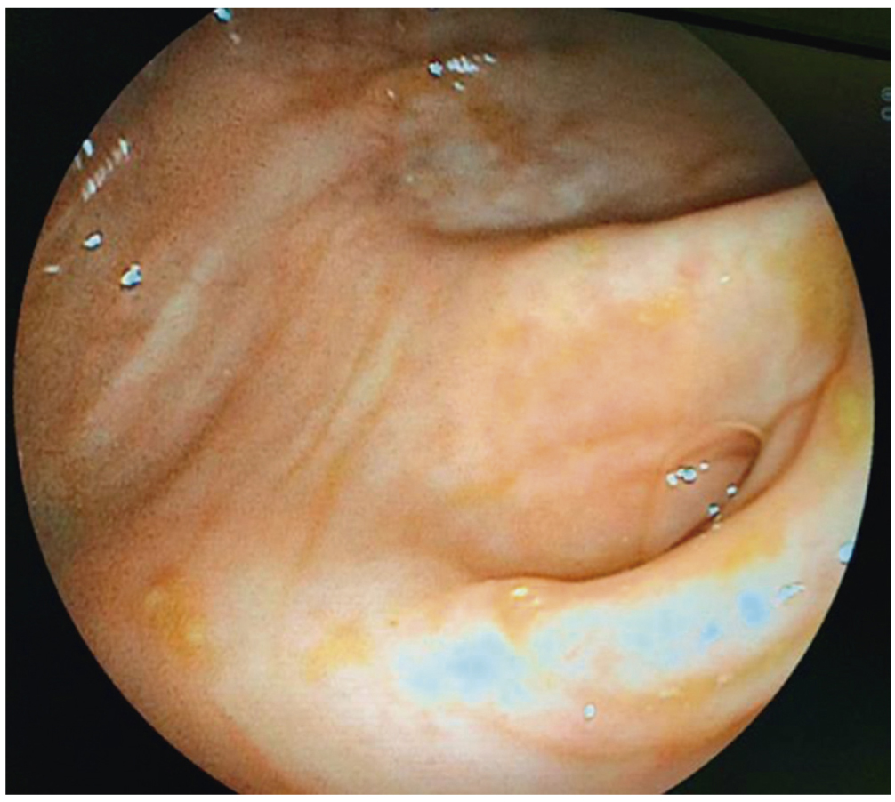 Orificio apendicular sano en la colonoscopia
