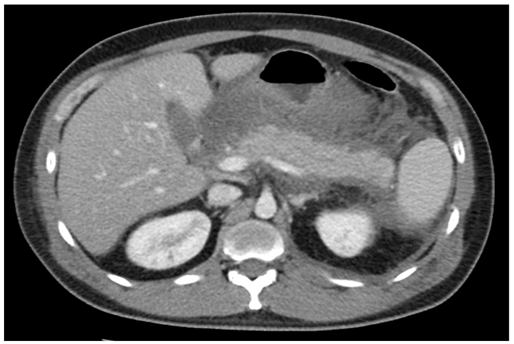 Figura 1. TAC de abdomen. Pancreatitis intersticial edematosa asociada con múltiples colecciones peripancreáticas apicales.