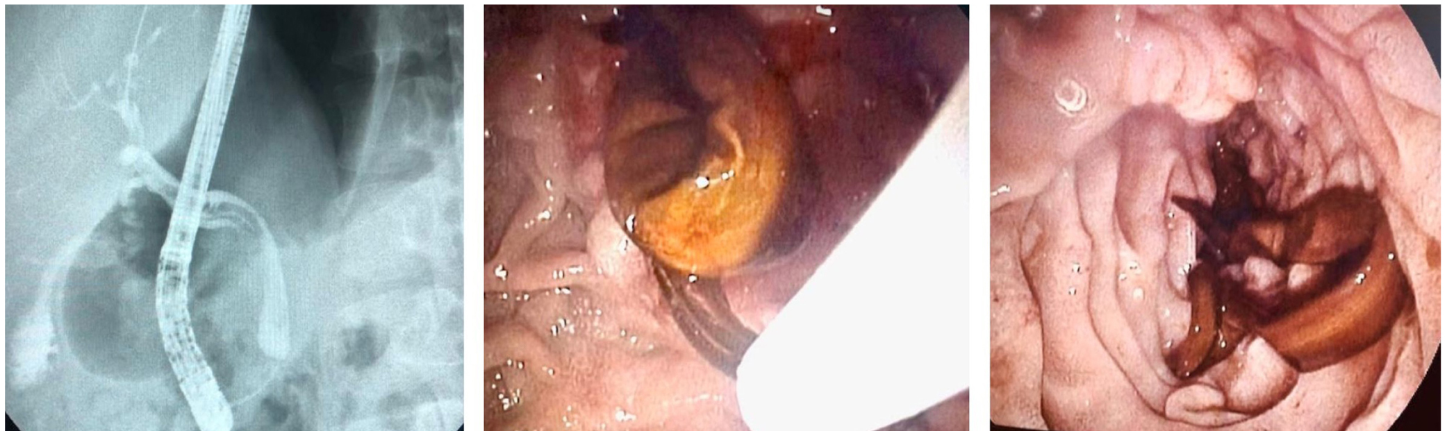 Figura 3. CPRE: vía biliar levemente dilatada de 7 a 8 mm, con defecto de llenado alargado e imagen en doble riel, por presencia de áscaris.
