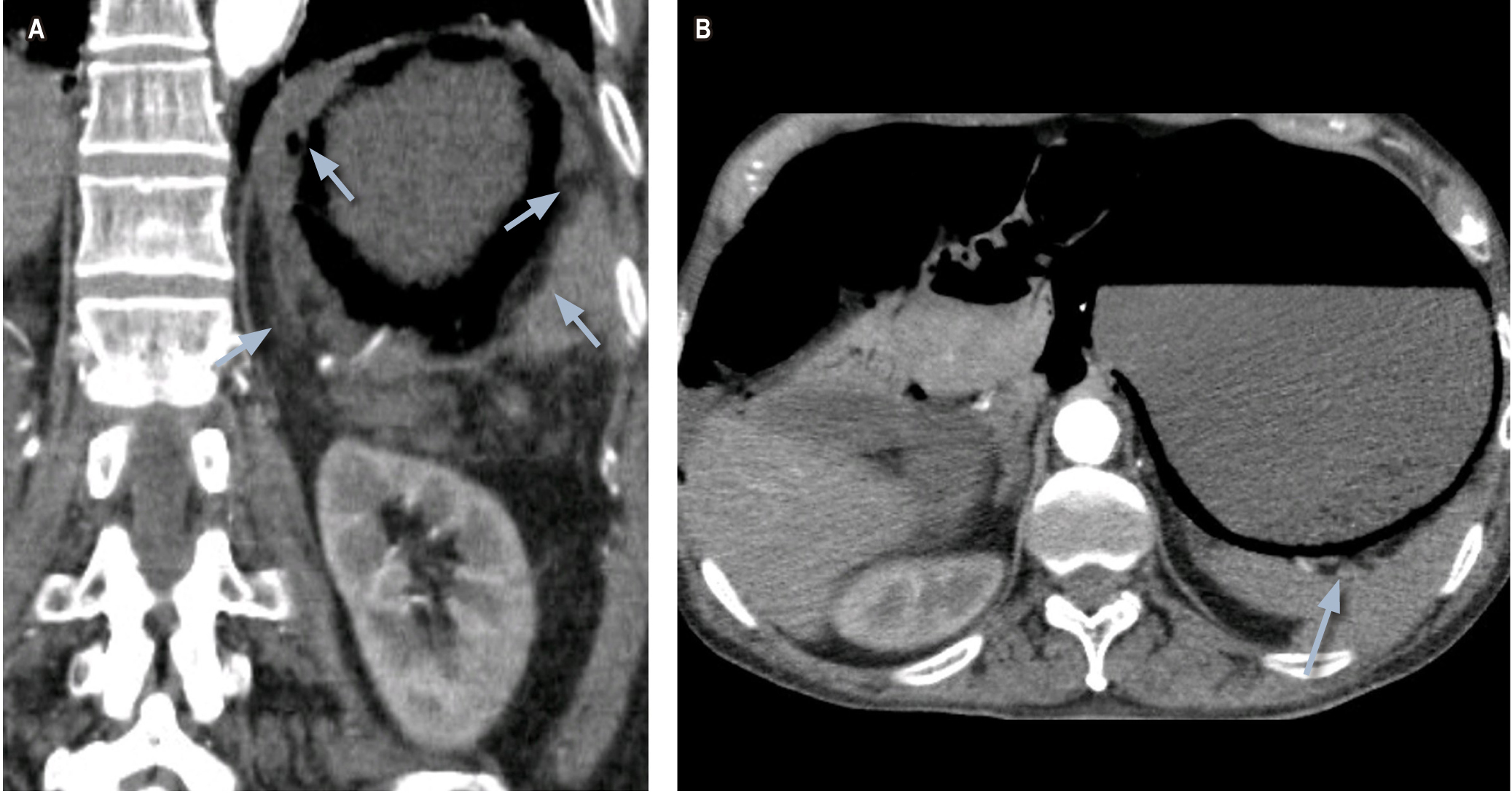 Figura 1. Tomografía abdominal con contraste del paciente