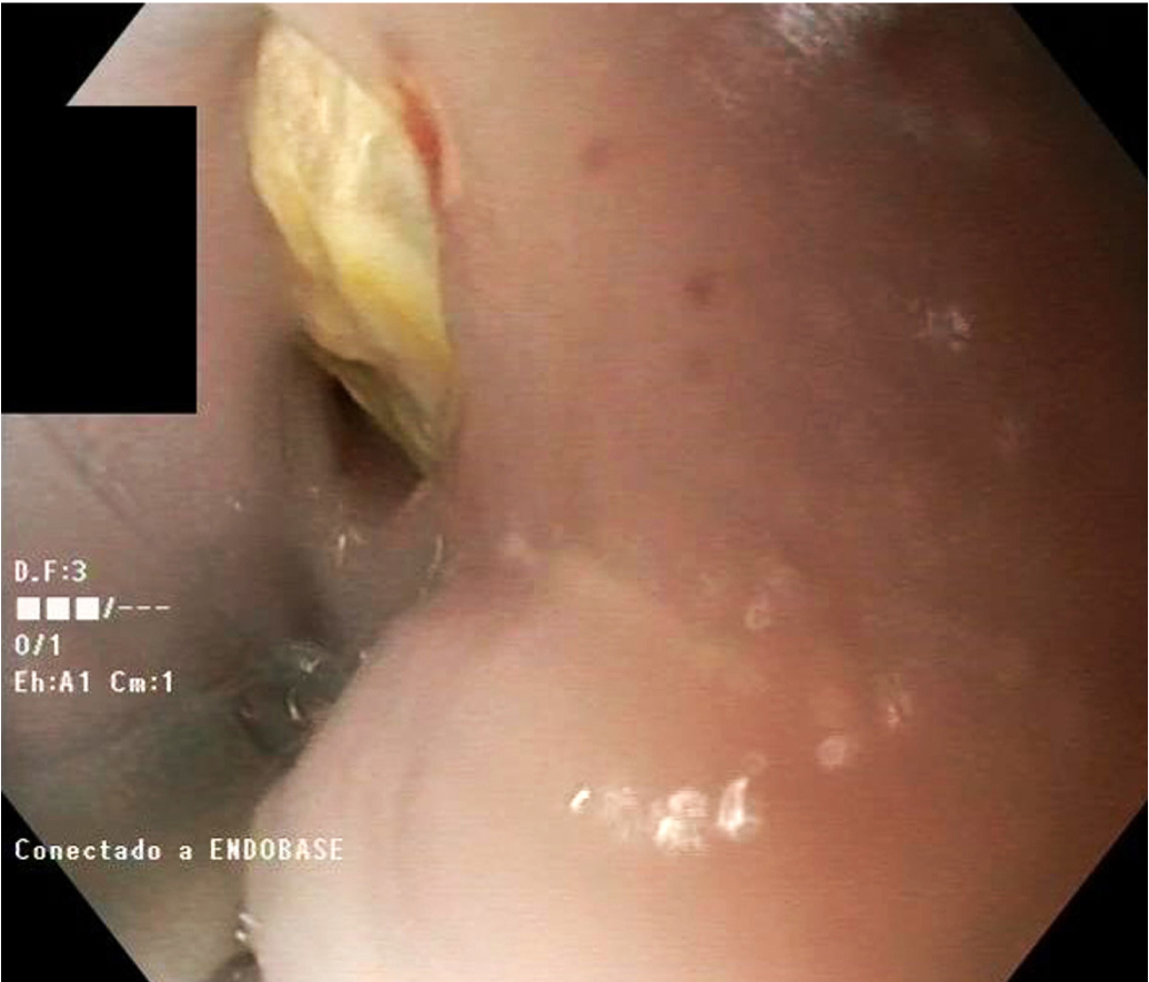 Figura 1. Imagen endoscópica del orificio fistuloso en el esófago.