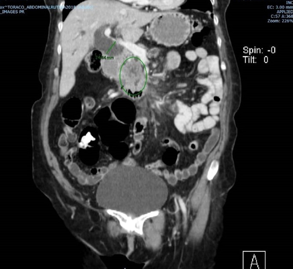 Figura 3. Masa de la cabeza del páncreas, dilatación de la vía biliar intra y extrahepática
