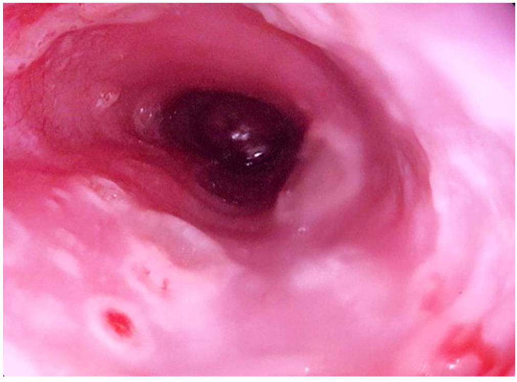 Figura 3. Videoendoscopia alta en la que se muestra la presencia de úlceras de 5 mm con bordes sobreelevados con fondo eritematoso en el esófago distal.