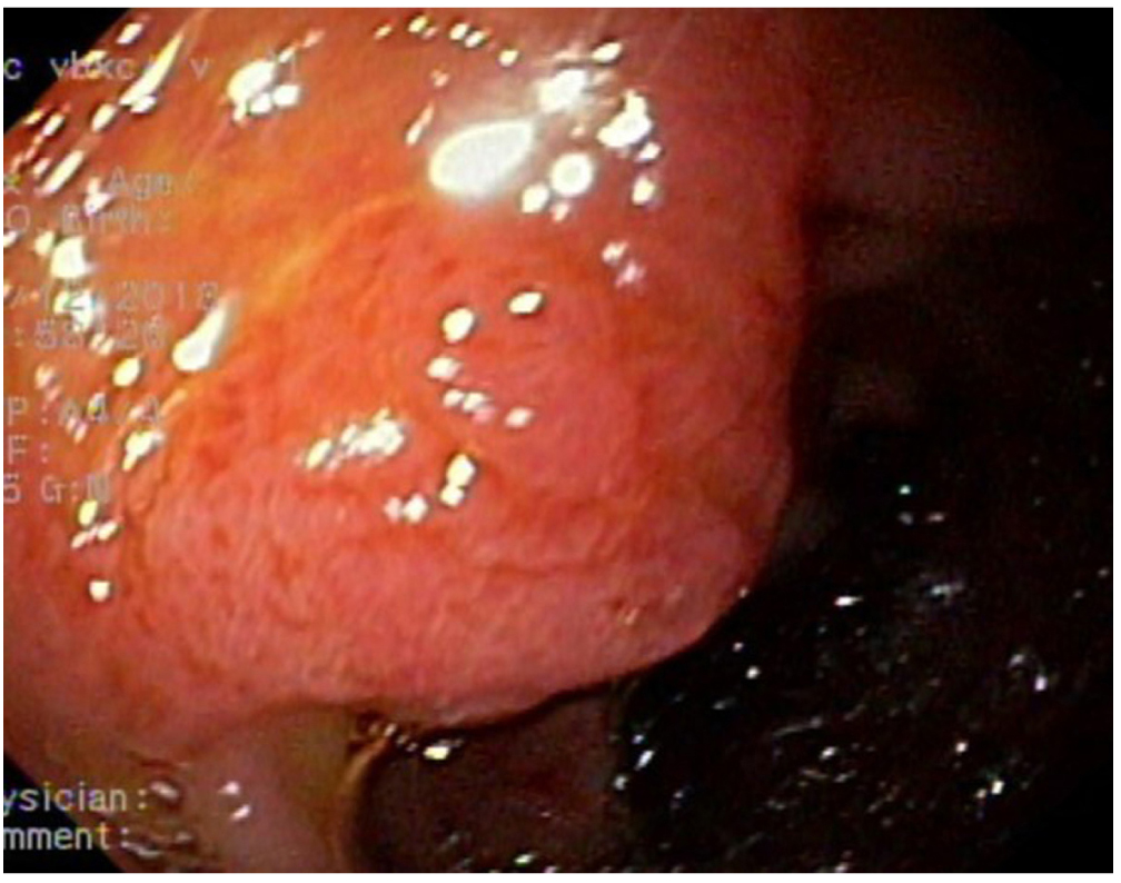 Figura 1. Imagen endoscópica del adenoma de la papila menor.