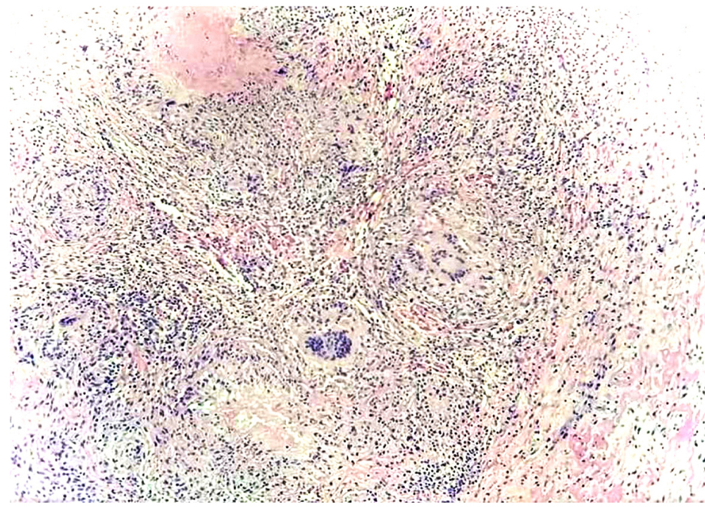 Figura 3. Biopsia de peritoneo que evidencia un proceso inflamatorio granulomatoso
