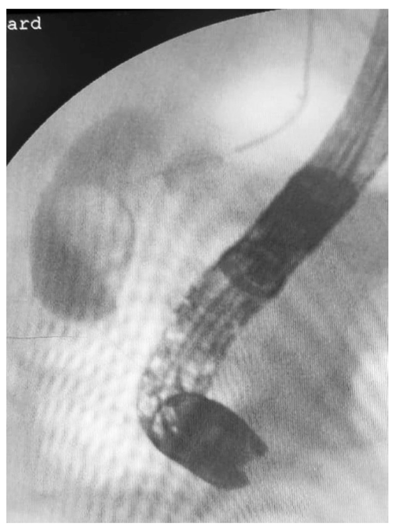 Figura 1. Fluoroscopia intraoperatoria-colangiopancreatografía retró-grada endoscópica, acceso a la vía biliar