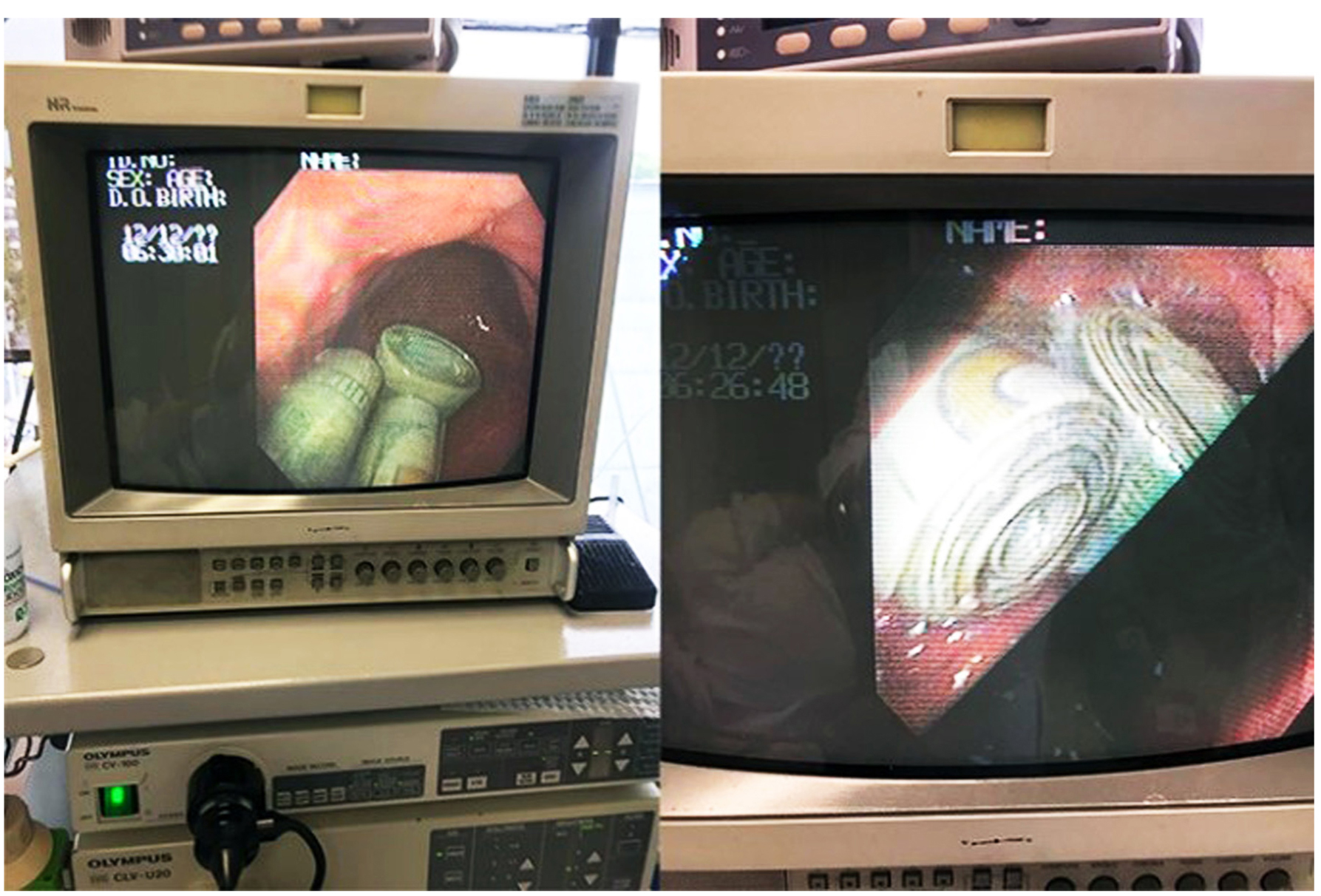 Figura 1. Bezoar de dinero que generó un síndrome pilórico observado en el monitor de laparoscopia