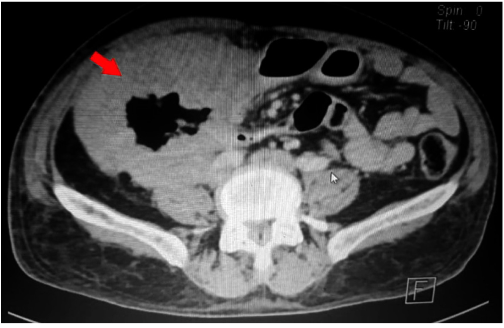 Figura 1. TAC de abdomen en corte transversal. Se observa un engrosamiento de la pared del colon derecho, como se observa en la flecha roja.