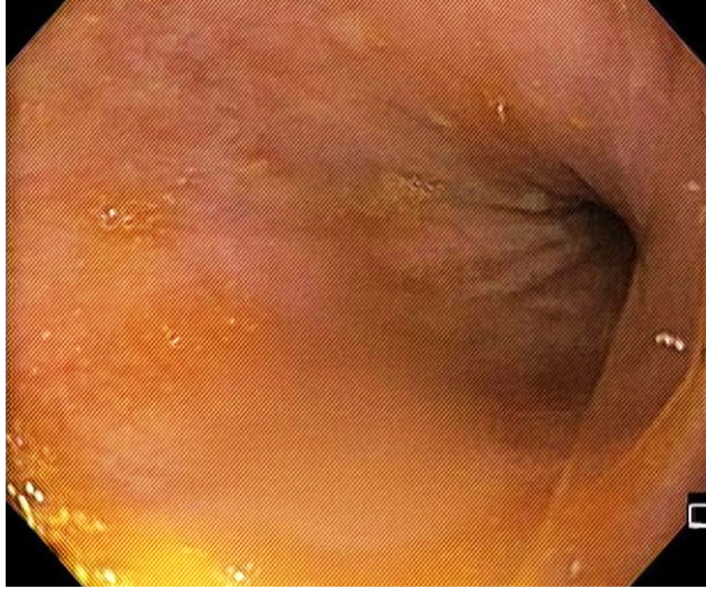 Figura 3. Imagen durante realización de endoscopia de vías digestivas altas y devolvulación endoscópica