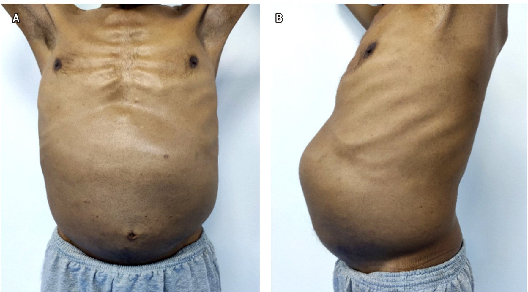 Figura 1. A. Se observa al paciente con distensión abdominal. B. Se observa el abdomen dilatado con presencia de la masa a nivel del epigastrio, mesogastrio e hipocondrio izquierdo.