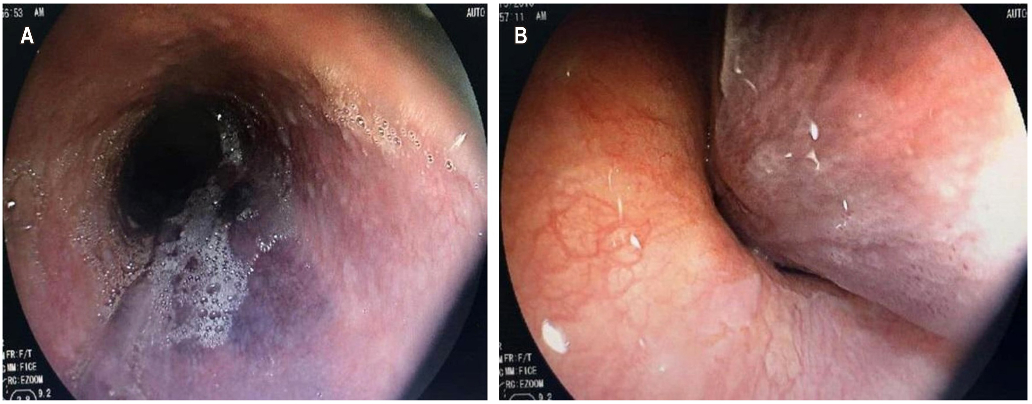 Figura 2. A. EVDA: esófago-hematoma; B. Hematoma de la pared lateral izquierda que se extiende hasta el cardias, condicionando la compresión intraluminal