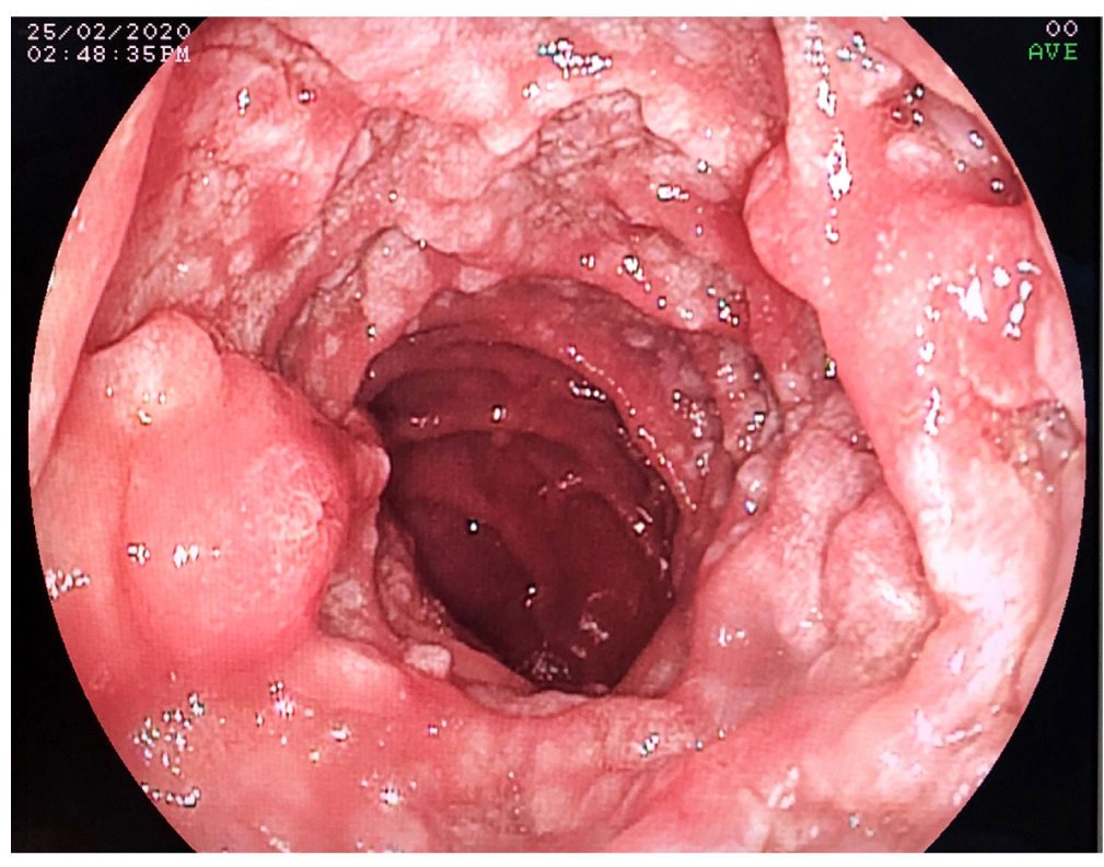 Figura 1. Hallazgos endoscópicos: lesiones nodulares de aspecto granular en la segunda porción del duodeno.