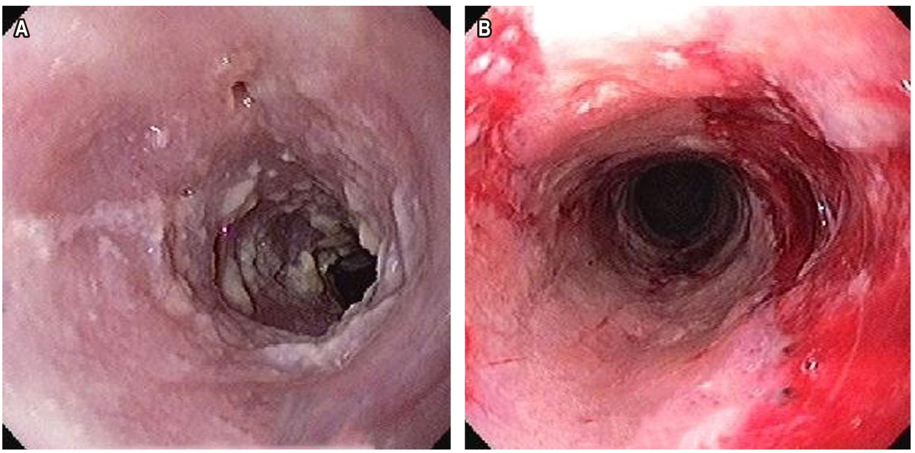 Figura 1. Imágenes endoscópicas del PDIE del paciente del caso 1. A. Imagen de diagnóstico de PDIE por moniliasis. B. Imagen después de la dilatación endoscópica