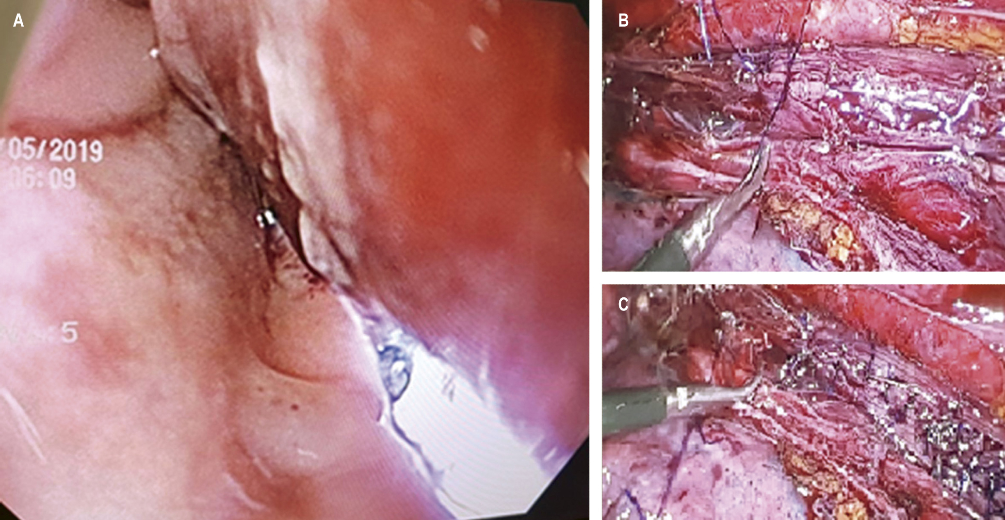 Figura 3. A. Visión endoscópica de la perforación esofágica con transiluminación externa por el laparoscopio. B y C. Esofagografía por toracoscopia con puntos simples