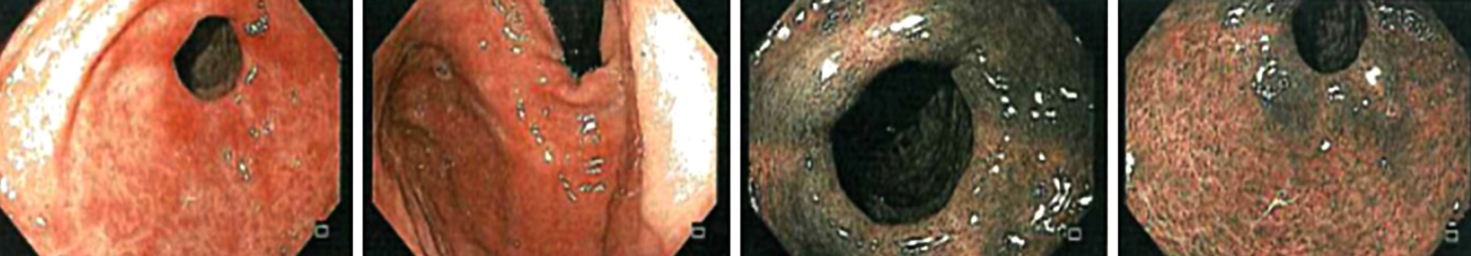 Figura 2. Esofagogastroduodenoscopia: mucosa del cuerpo con eritema en parches que no evidencia el borde atrófico ni hallazgos adicionales. Se realiza una revisión con imagen de banda estrecha (NBI) para permitir la toma de biopsias