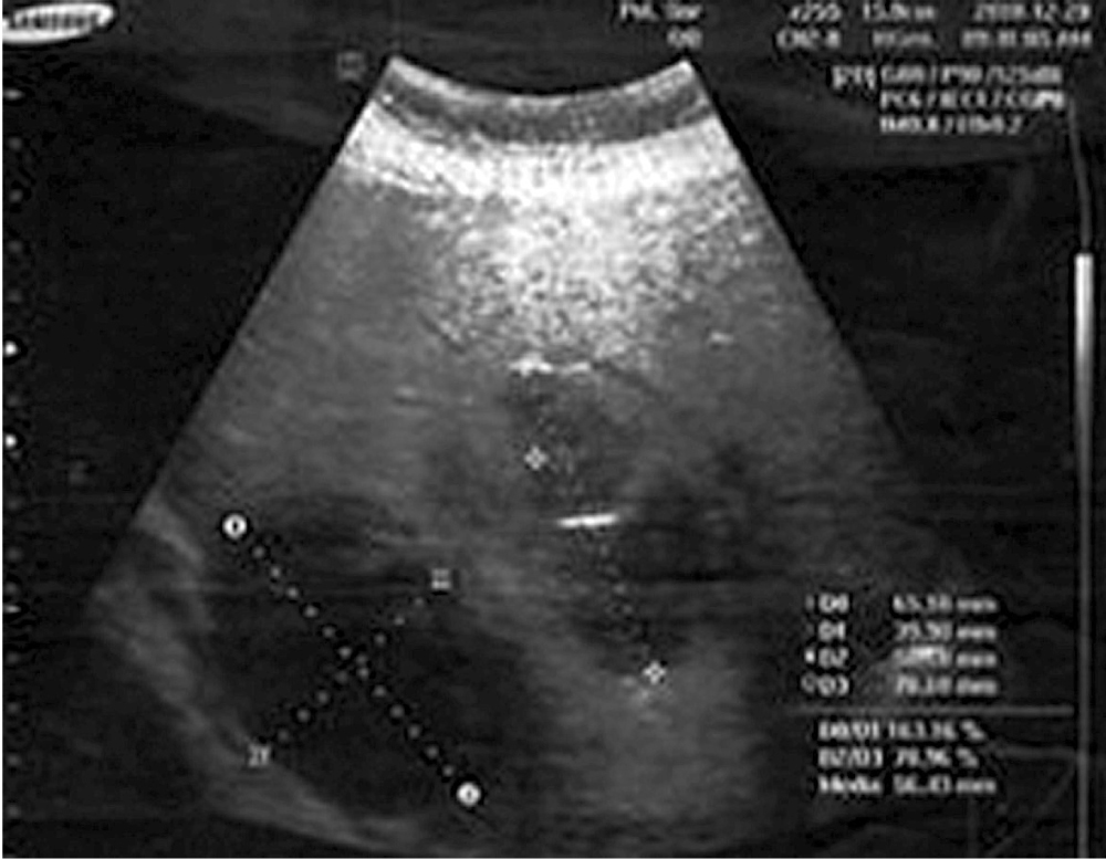 Figura 1. Ecografía de hígado. Impresión diagnóstica: absceso hepático múltiple. Tomografía axial computarizada (TAC) abdominal contrastada N.º 0077-19