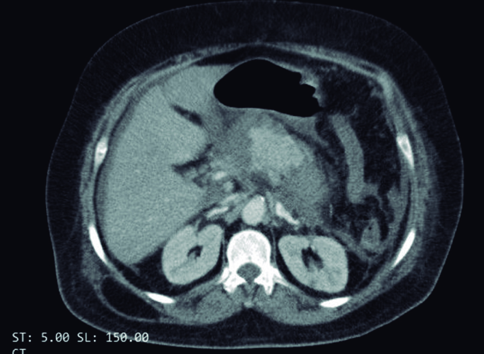 Figura 1. Tomografía axial computarizada (TAC) que revela una pancreatitis aguda necrotizante primordialmente de la cabeza y cuerpo del páncreas. Fuente: archivo de los autores.