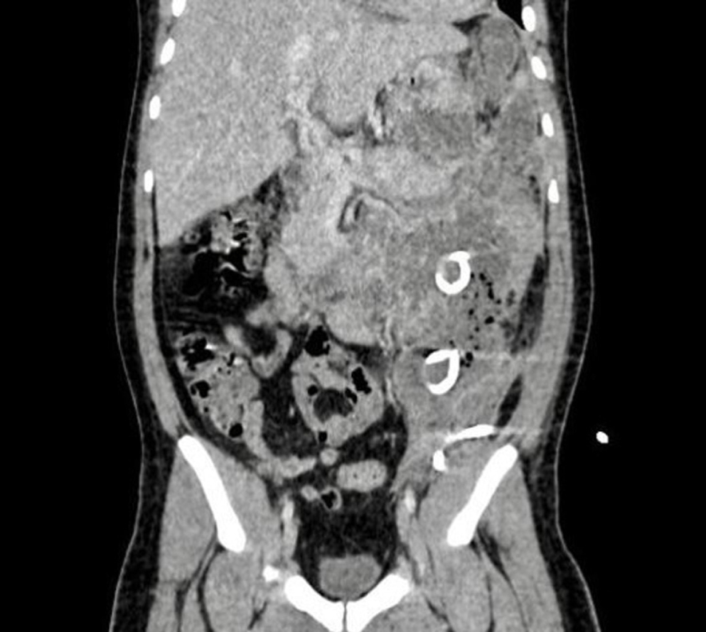 Figura 1. Tomografía de abdomen contrastada. Corte coronal. Se observan los drenajes percutáneos. Imagen propiedad de los autores.
