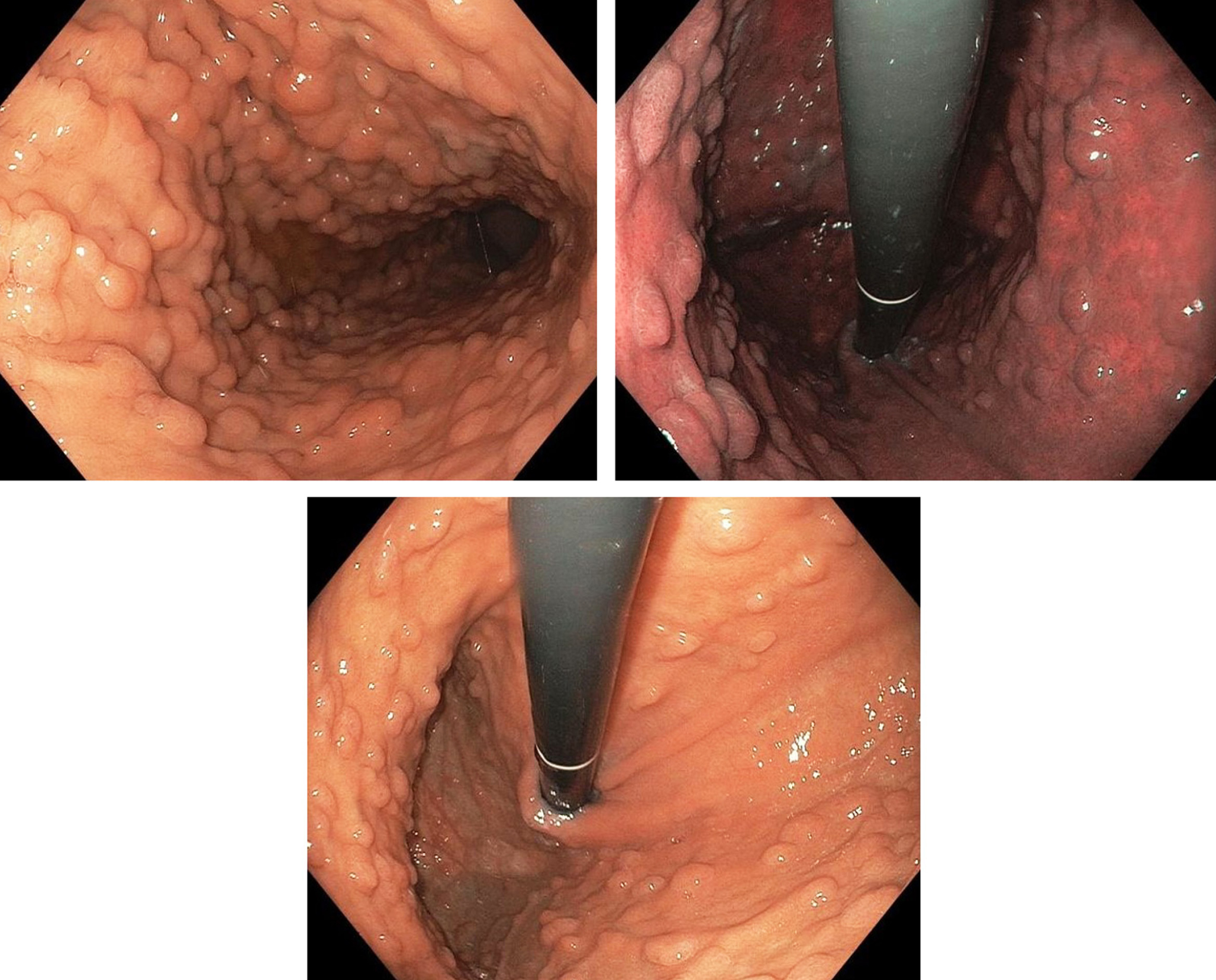 Figura 1. Endoscopia digestiva alta que muestra extensa poliposis difusa del estómago. Imágenes propiedad de los autores.