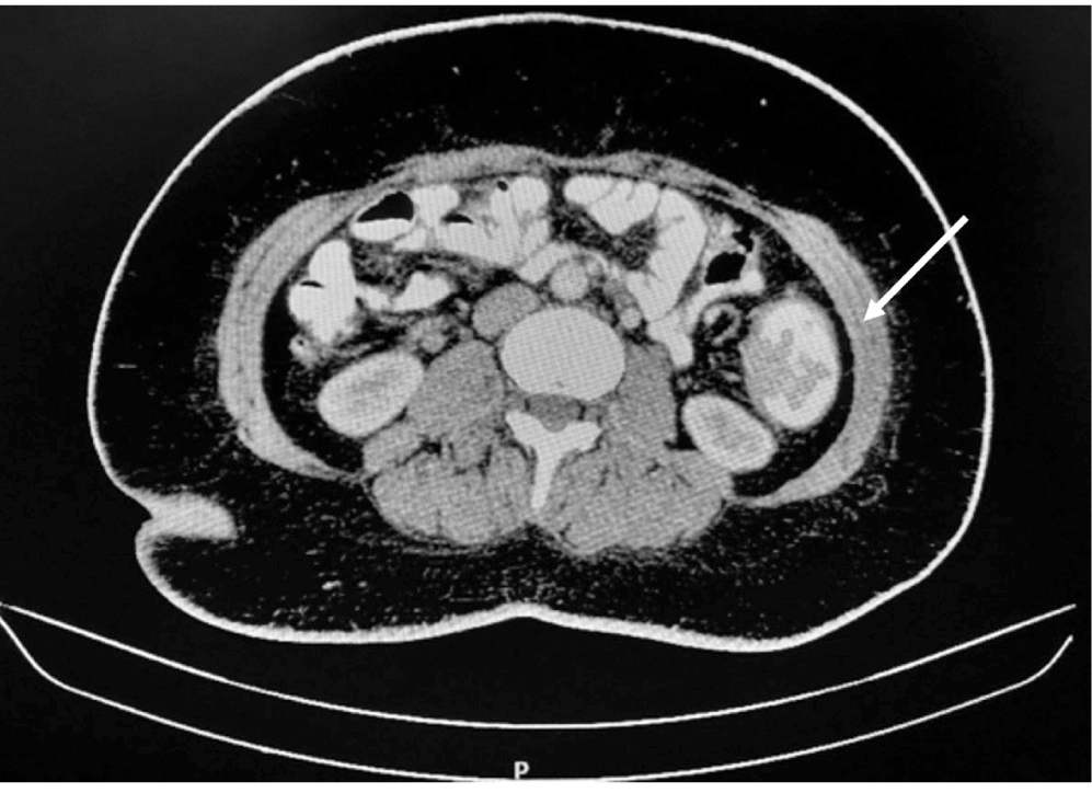 Figura 1. TAC de abdomen con contraste realizado durante la admisión en el que se muestra un tumor dependiente del colon sigmoides con gran compromiso de la luz intestinal.