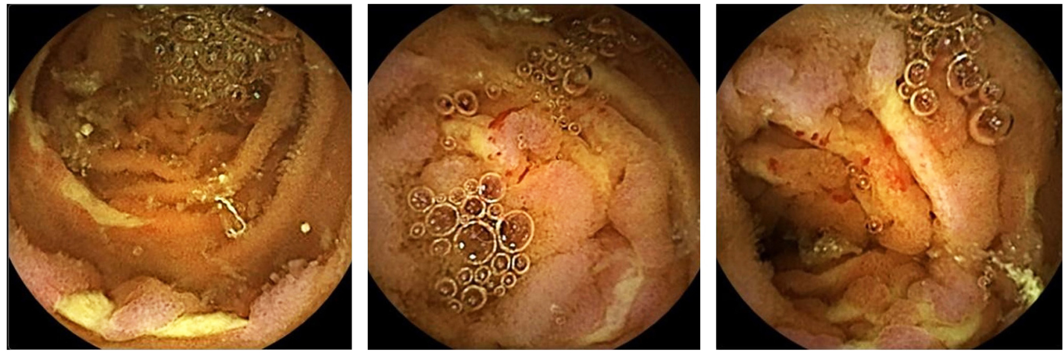 Figura 1. Se observan múltiples úlceras profundas, recubiertas por fibrina, con compromiso circunferencial y con focos de sangrado activo escaso. Mucosa con congestión y edema grave, sin signos de necrosis.