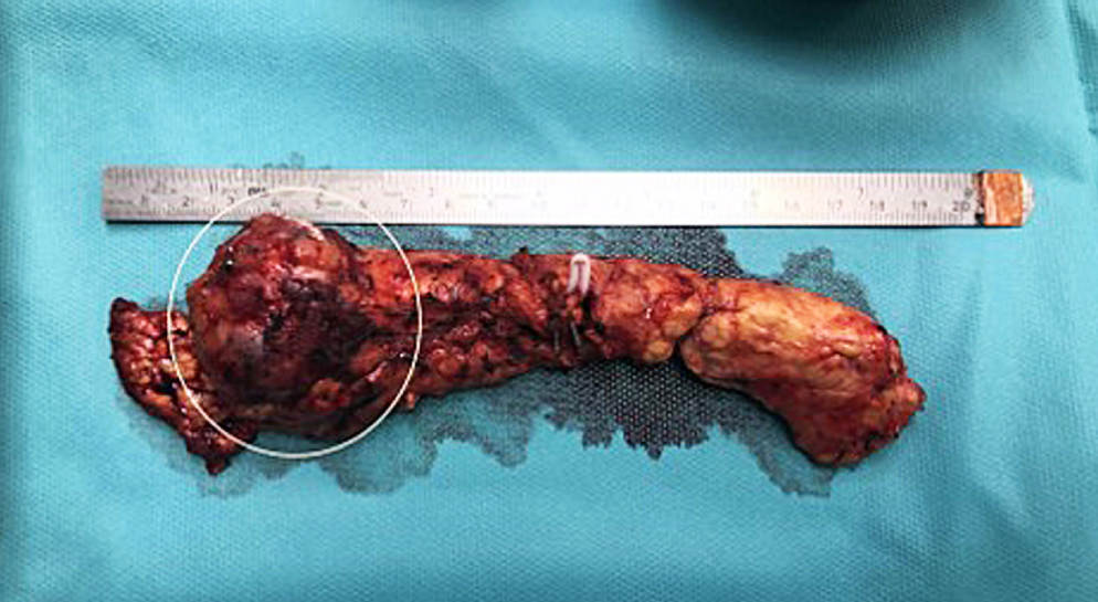 Figura 1. Tumor en el cuello del páncreas. Fuente: archivo de los autores