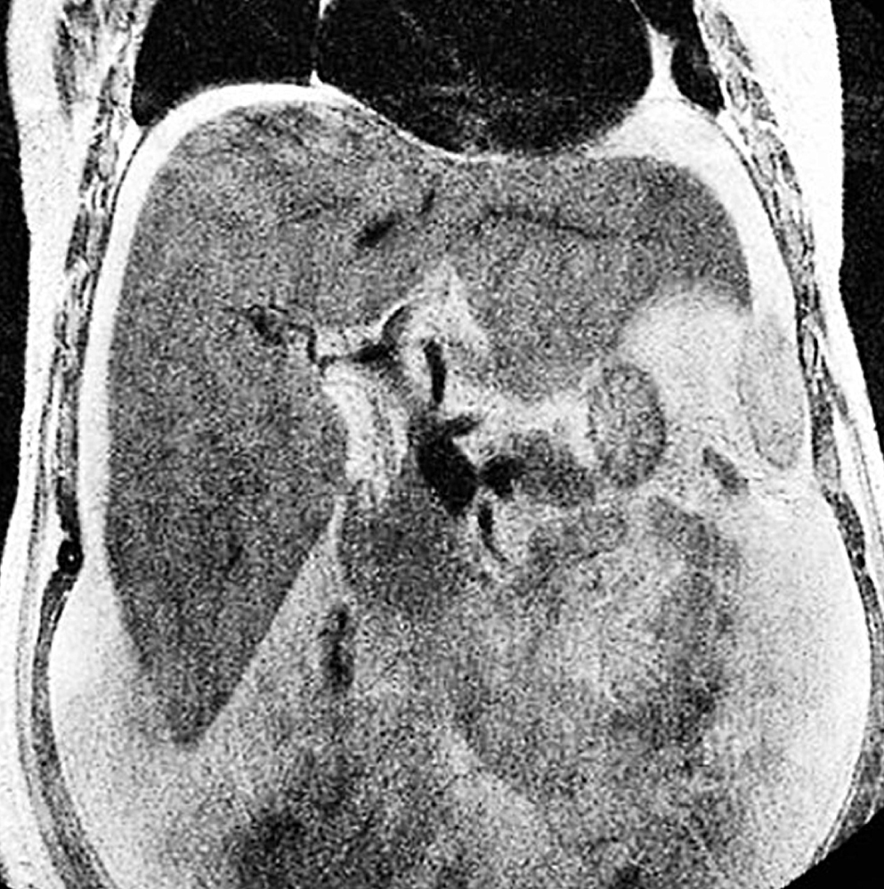 Figura 1. Afinamiento de las venas suprahepáticas (MRI). Fuente: Servicio de Radiología, Hospital Víctor Lazarte Echegaray