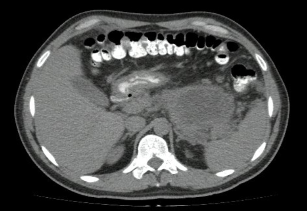 Figura 1. Tomografía de abdomen. Fuente: archivo de los autores