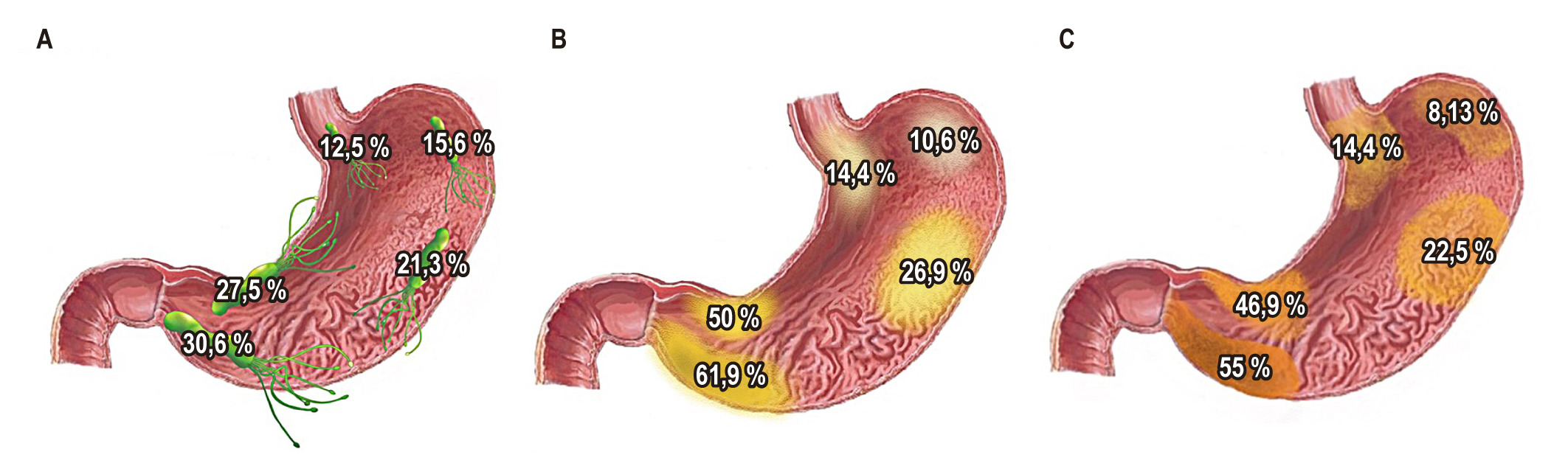 Figura 1. Prevalencia y distribución de H. pylori (A), atrofia (B), metaplasia intestinal (C) en pacientes con diagnóstico previo de condiciones preneoplásicas en Colombia