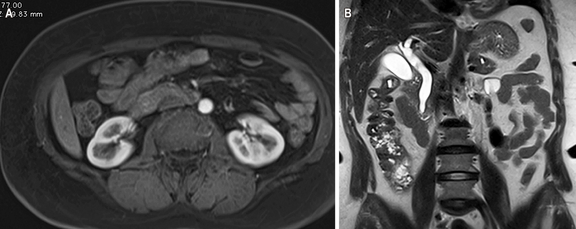 Figura 2. Resonancia magnética contrastada con evidencia de dilatación en la vía biliar intra- y extrahepática secundaria a lesión periampular (A) en corte axial y (B) corte coronal. Fuente: archivo de los autores