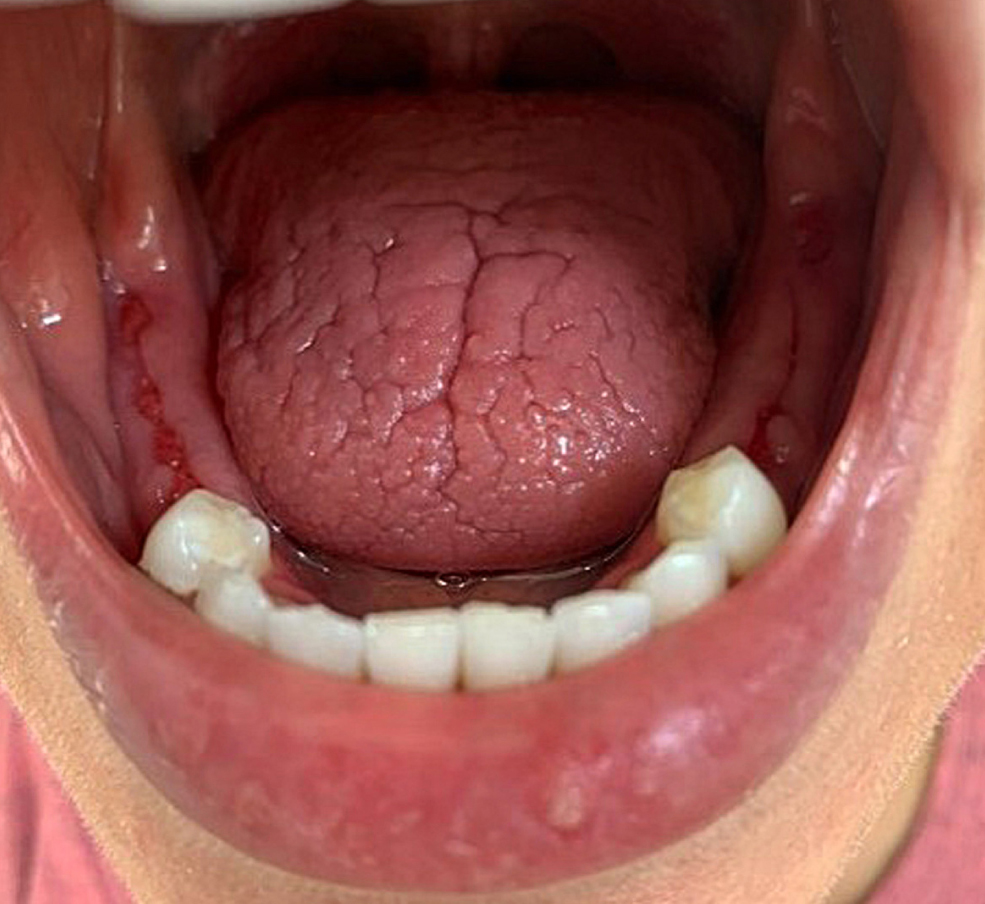 Figure 1. Dorsal tongue with depapilation and deep fissures without ulceration, findings compatible with glossitis resulting from oral xerostomia. Evidence of areas of post-extraction scarring in the lower alveolar ridge mucosa before implant treatment. Common nonspecific oral manifestations associated with inflammatory bowel disease (IBD). Authors’ archives.