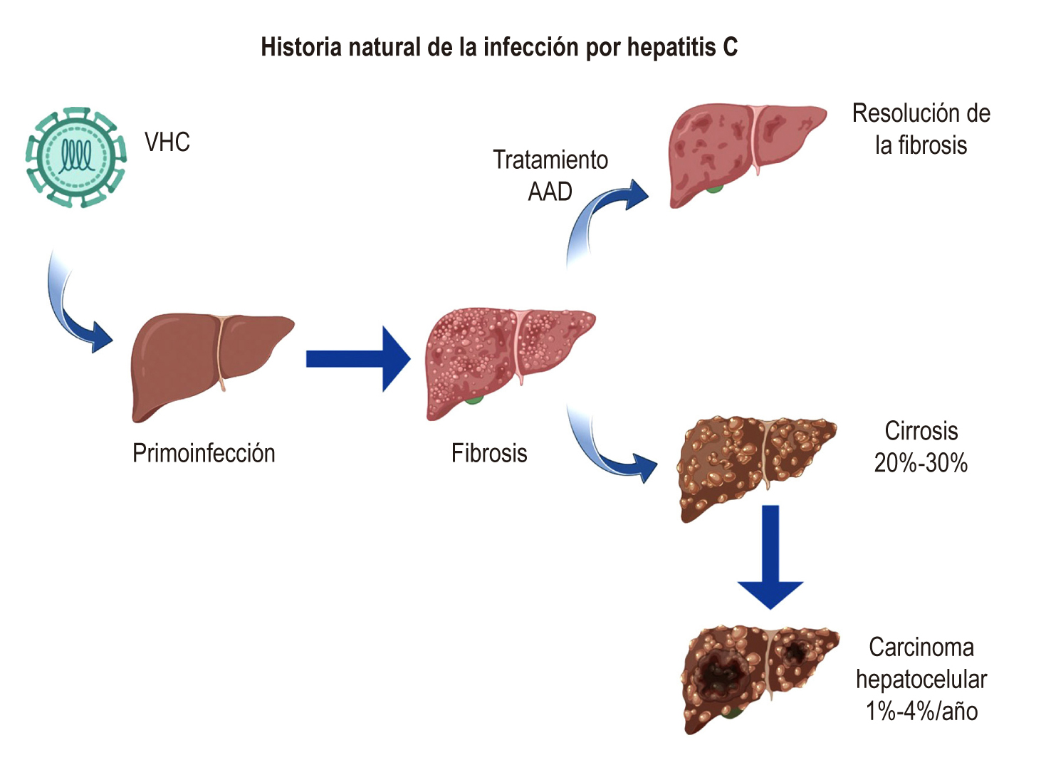 Figura 1. Historia natural de la infección por hepatitis C. AAD: antivirales de acción directa. Adaptado de Lingala y colaboradores