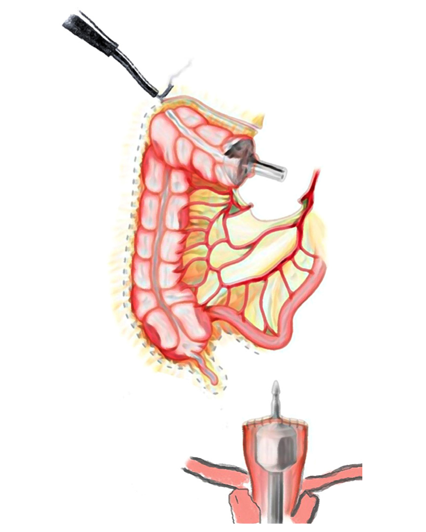 Figura 1. Liberación y movilización del colon derecho por vía laparoscópica con energía monopolar y pinza Hook. Imagen propiedad de los autores.