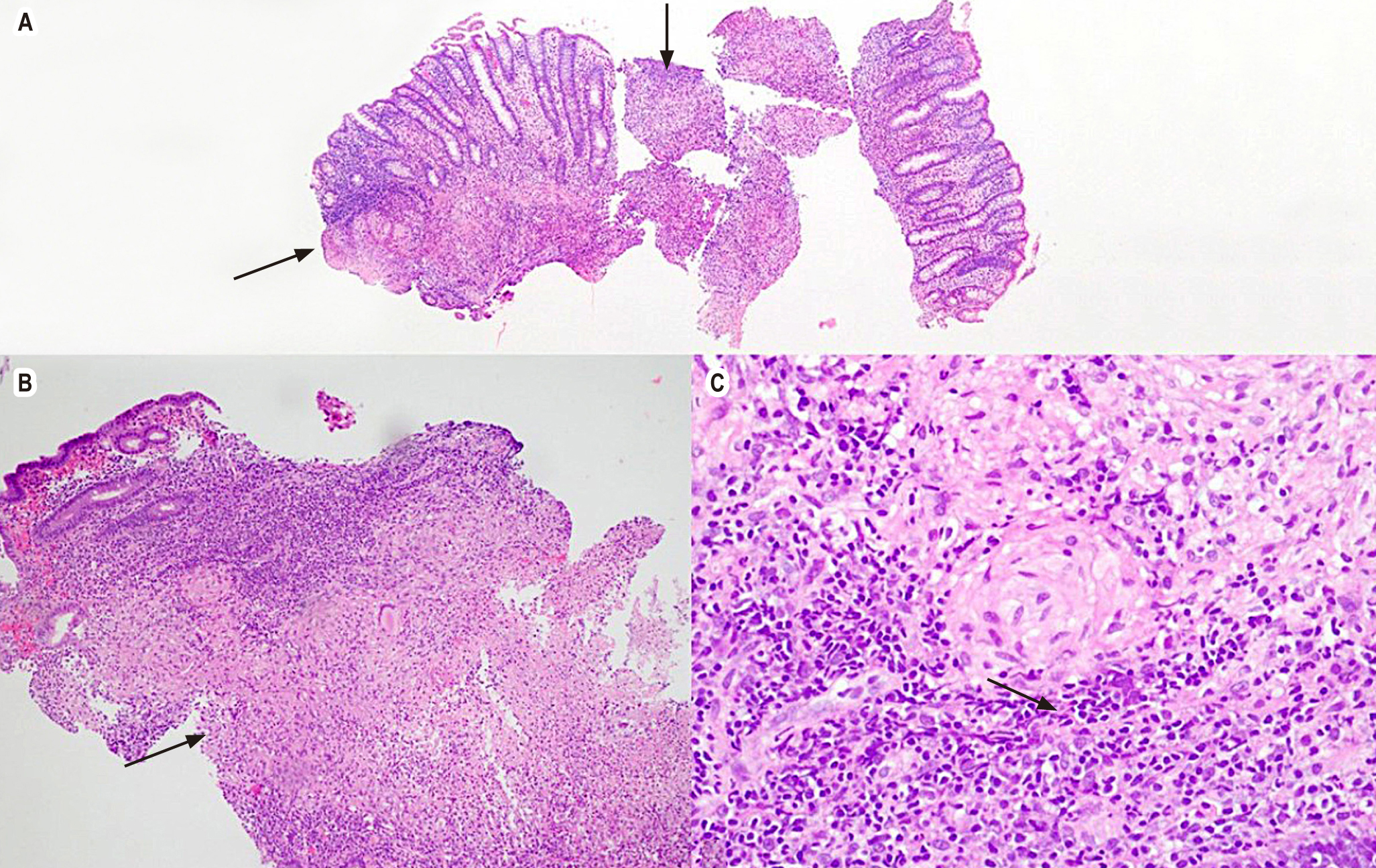 Figure 2. Granulomatous colitis with hematoxylin and eosin. A. 4x, colonic mucosa, arrows point to granulomas. B. 10x, the lamina propria shows the formation of well-defined granulomas and some neutrophil abscesses. C. 40x, epithelioid granuloma. Source: Patient’s medical record.