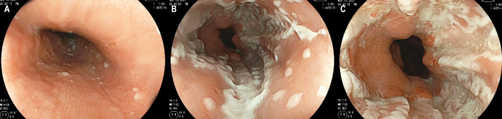 Figure 1. Upper endoscopy of the patient with herpetic esophagitis, lesions in different stages of evolution, from isolated vesicles to erosions and confluent ulcers. A. Proximal esophagus. B. Middle esophagus. C. Distal esophagus. Authors’ archives.