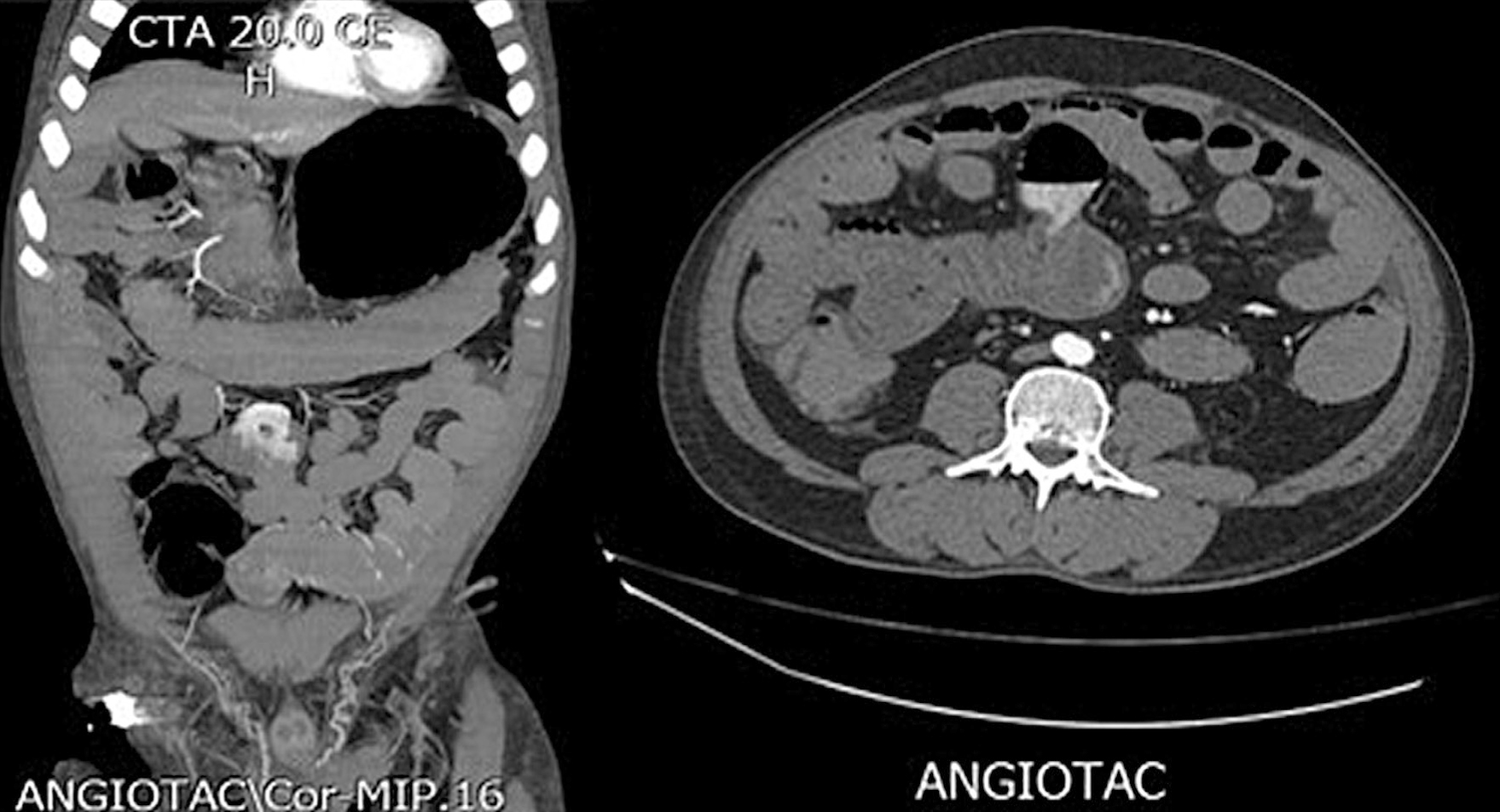 Figure 1. Computed axial tomography showing a thin-walled cystic structure with an air-fluid level corresponding to a jejunal diverticulum. Source: Radiology Service, Hospital Comuneros. Selected by the authors.