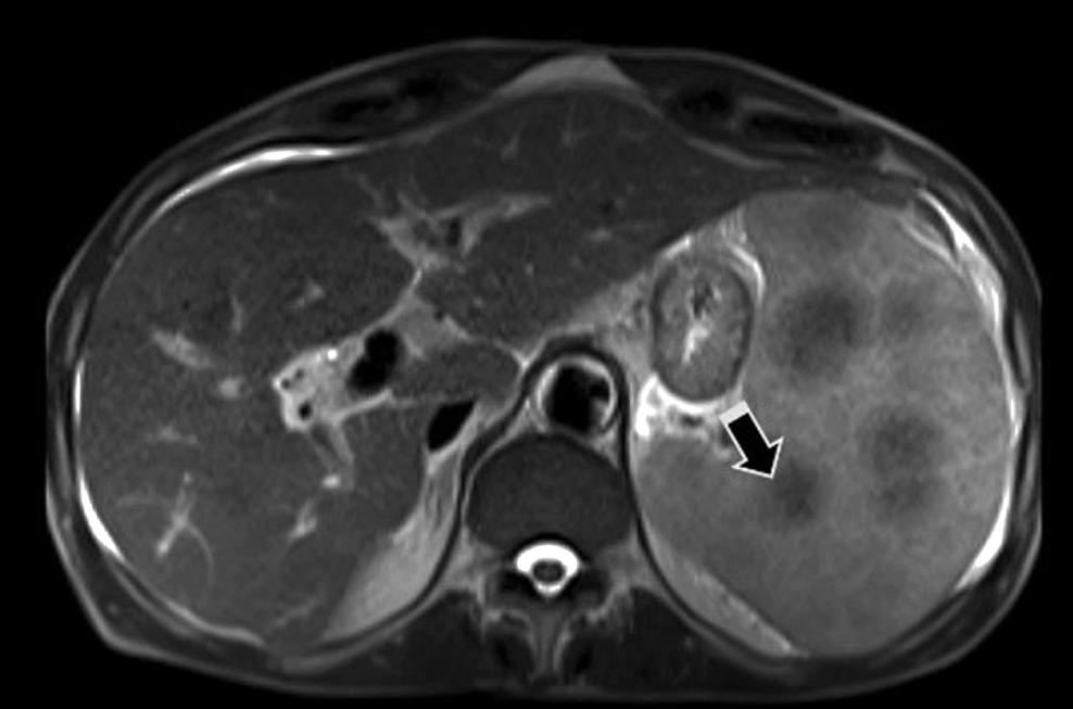 Figura 1. RM de abdomen que muestra nódulos hipointensos en el bazo (flecha), adenomegalias en el hilio hepático y retroperitoneales. Además, se evidencia un patrón nodular de implantes peritoneales perihepáticos y en el omento mayor. Archivo de los autores.