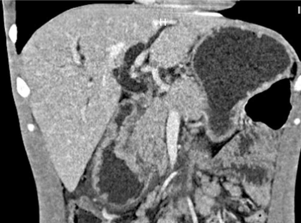 Figura 1. Tomografía de abdomen simple y contrastada: dilatación de la vía biliar intra- y extrahepática con un colédoco de 14 milímetros, el páncreas con ligera dilatación del conducto Wirsung y pérdida de los contornos a nivel de la cabeza. 