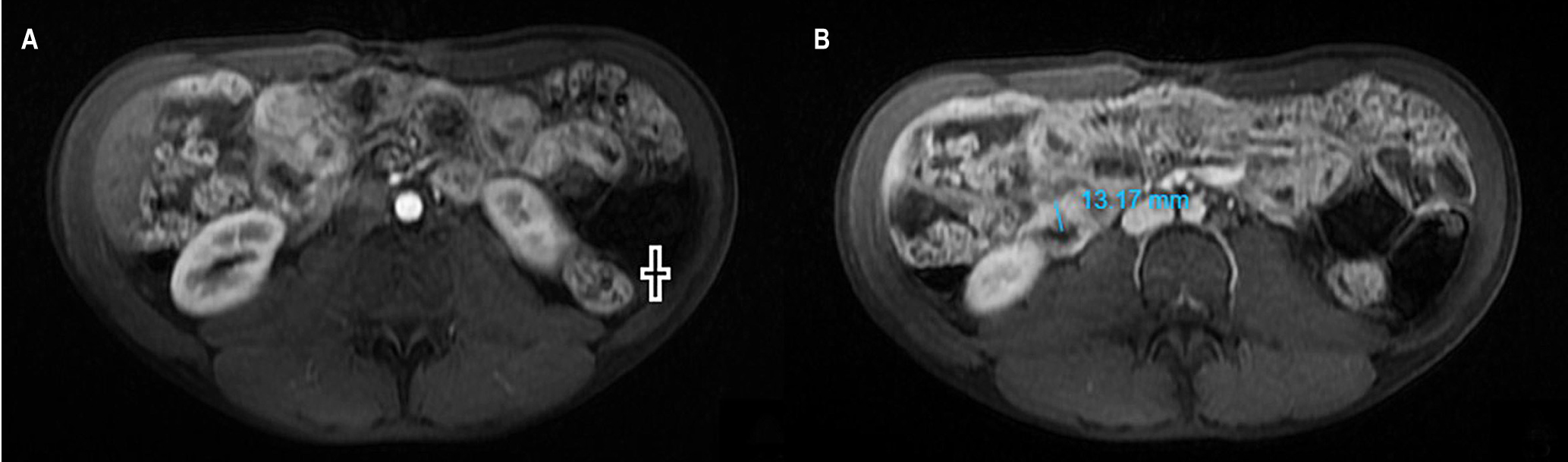 Figure 1. MRE with contrast. A. In the arterial phase: thickening of the ileus (+). B. In the portal phase: thickening of the ileum with a wall of 13 millimeters. Image owned by the authors.
