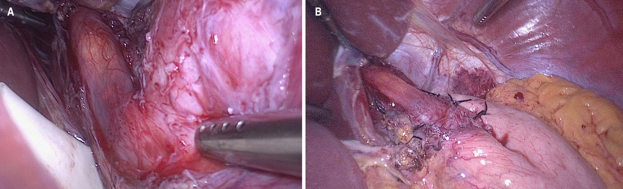 Figura 1. Técnica quirúrgica. A. Miotomía completa y verificación con endoscopia intraoperatoria. B. Funduplicatura parcial posterior (Toupet). Fuente: archivo de los autores.