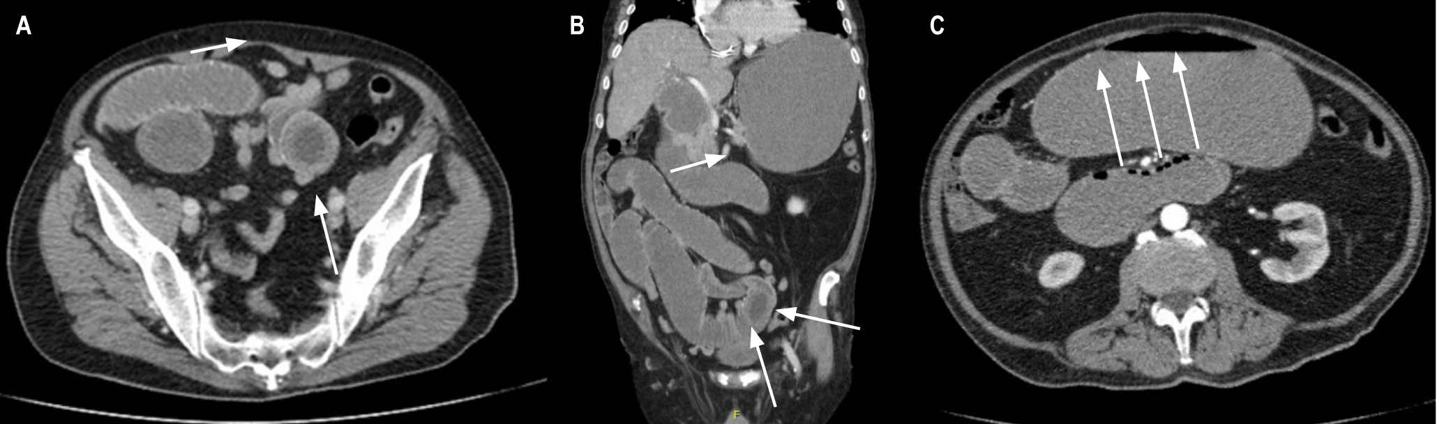 Figura 1. A y B. Imagen en diana de tomografía abdominal sugestiva de obstrucción intestinal por intususcepción. C. Imagen de collar de perlas sugestiva de obstrucción intestinal. Imágenes propiedad de los autores.