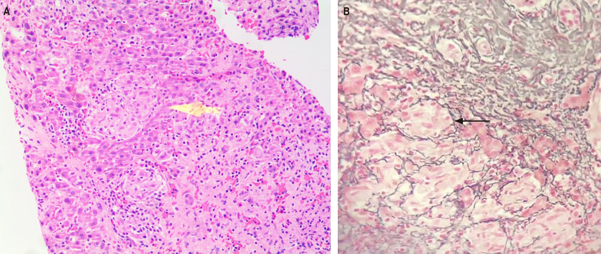 Figure 2. Liver biopsy. A. The sections show the liver parenchyma with numerous small granulomas, which are frequent in the periportal region, consisting of multiple compact aggregates of epithelioid cells with little lymphocytic infiltrate around them, without necrosis (hematoxylin and eosin, 100x); no fungi or mycobacteria were observed in the PAS and Ziehl-Neelsen stains (yellow arrow). B. In the reticulum stain, a cuff of fibrosis is noted around the granulomas (black arrow). The morphological findings correspond to granulomatous hepatitis (silver salt stain, 40x). Courtesy of Dr. María Mercedes Mendoza, pathologist, Hospital Militar Central. Bogotá, Colombia.